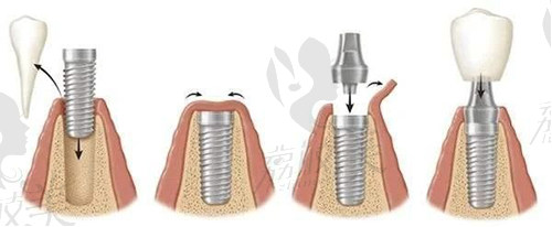 种植牙过程图