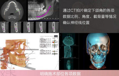 下颌角截骨CT检查