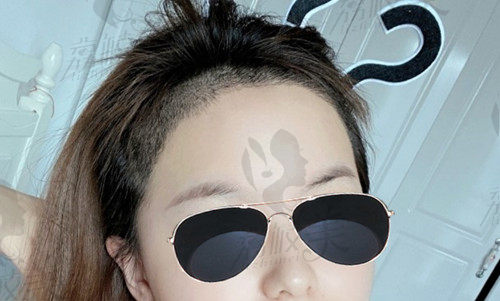 4000元植发7天后
