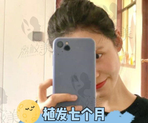 6000元植发术后