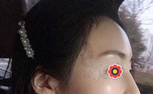 8000元植发术后