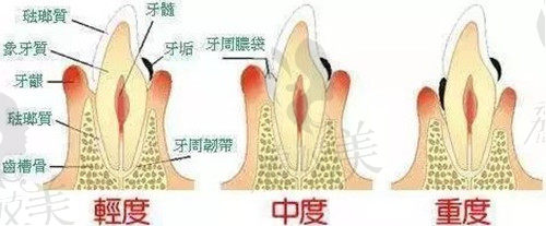 口腔健康对种植牙的影响