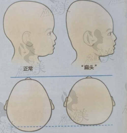 后脑勺扁平怎么矫正?上海时光何晋龙peek后脑勺填充技术挺靠谱