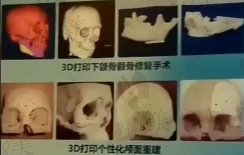 上海时光3D打印头颅重建