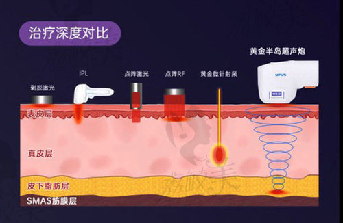 半岛超声炮治疗对比图