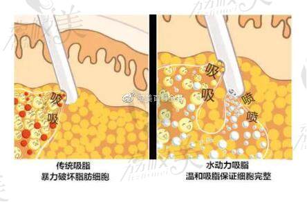 水动力吸脂和传统吸脂对比