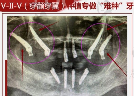 穿颧穿翼种植牙优势