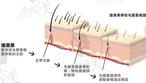 雄性激素脱发原理