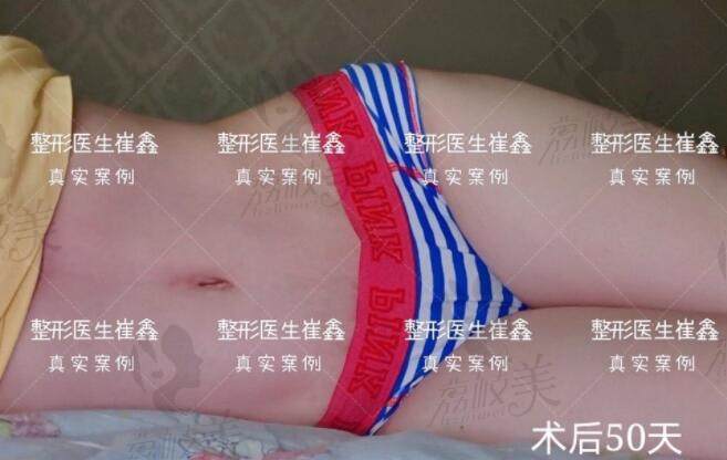 崔鑫医生腹壁成形术后50天