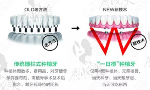 allon4种植牙和传统种植牙的对比