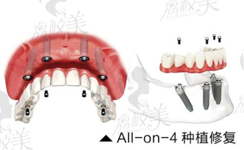 allon4种植牙修复牙齿缺失