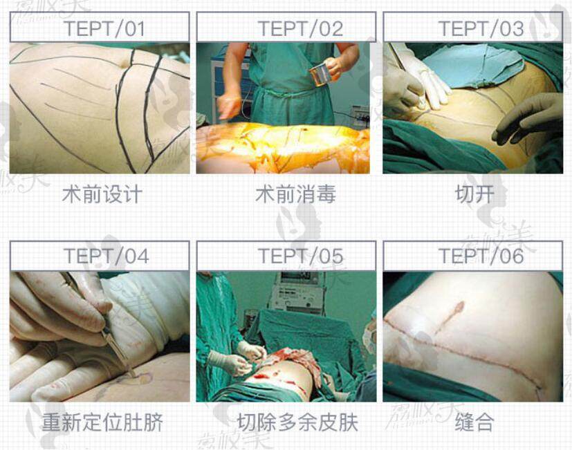 腹部成形术手术过程