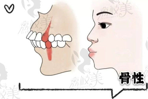 骨性凸嘴特征图