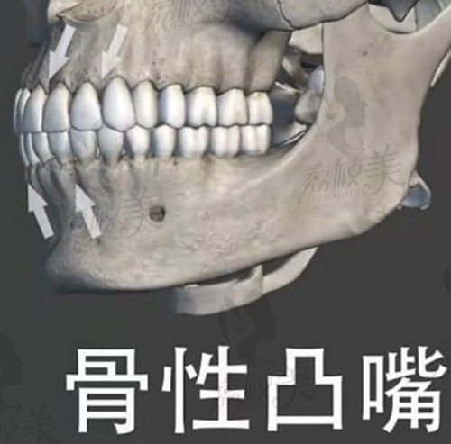 3DCT检查下的骨性凸嘴