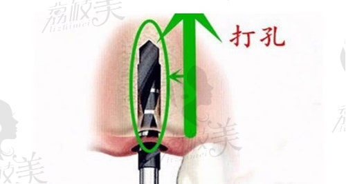 传统种植牙打孔植入植体