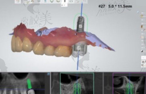 数字化种植牙计算机模拟