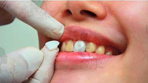 为什么医生不建议做牙齿贴面