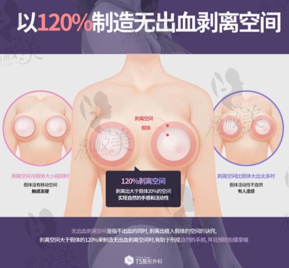 韩国TS假体隆胸技术特点