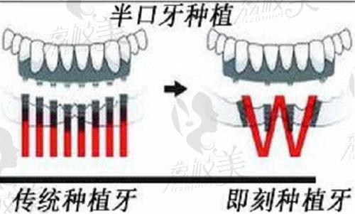 半口种植牙技术优势
