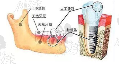 种植牙和牙槽骨