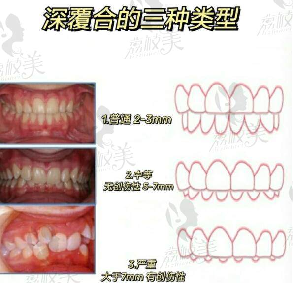 深覆合的三种类型