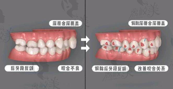 深覆合治疗的过程及步骤