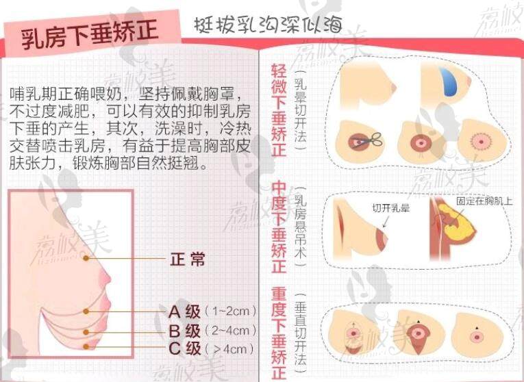 乳房下垂矯正的方式