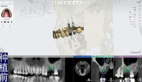 北京京品数字口腔数字化种植牙