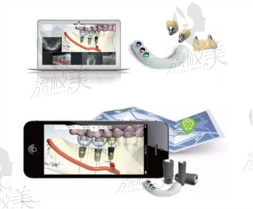 上海雅悦齿科数字化种植牙技术