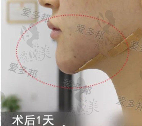 王绍国取生长因子术后1天