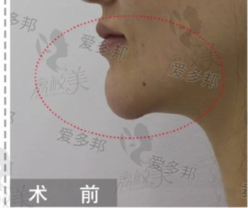 王绍国取生长因子术前
