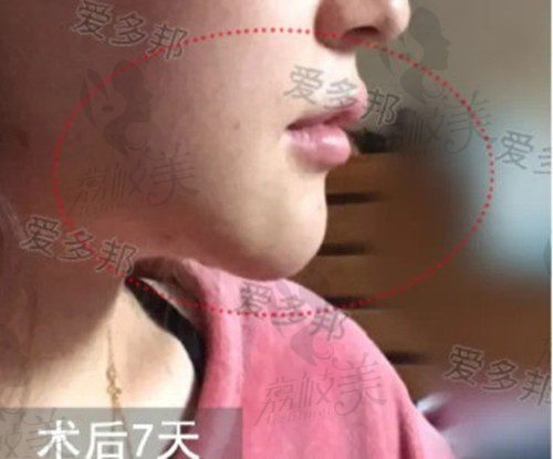 王绍国取生长因子术后7天