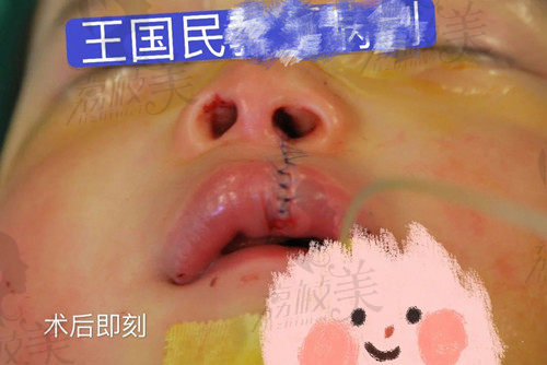 上海薇琳王国民做唇腭裂修复术后即刻