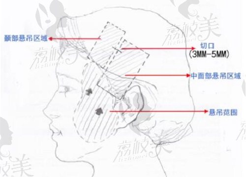 杨欣院长微创筋膜悬吊提升示意图