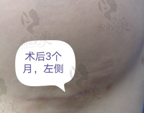 杭州美莱栗勇院长做隆胸术后3个月的疤痕