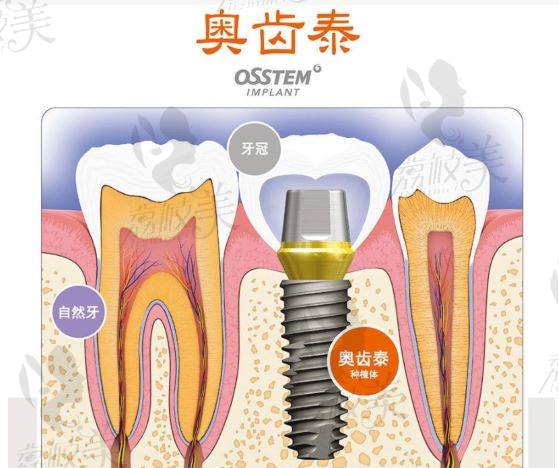 韩国奥齿泰种植体