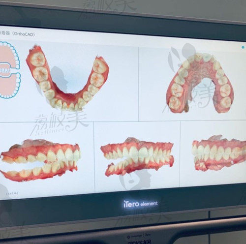 杭州雅宁口腔正畸口扫