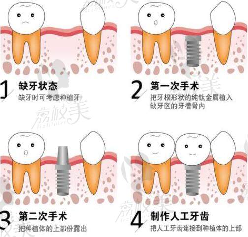 种植牙图片