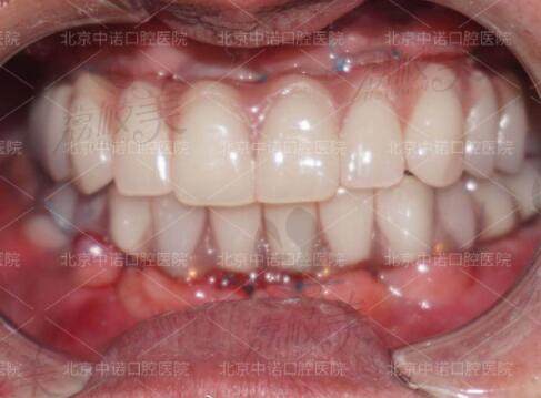 种植牙术后疗效展示
