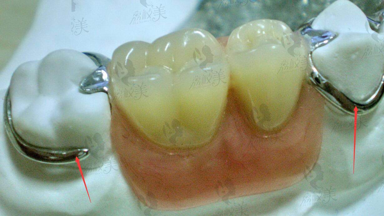 镶牙术后疗效展示
