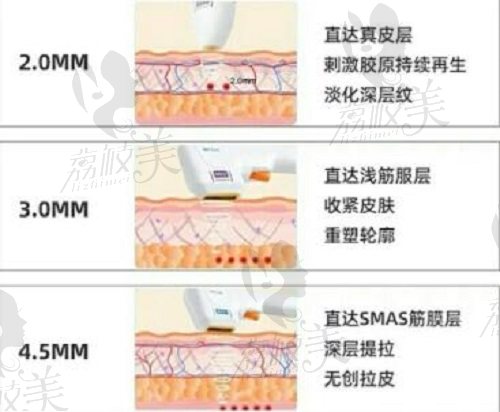 半岛超声炮炮头深度