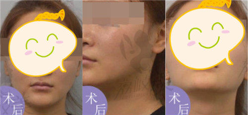 上海薇琳穆雄铮医生做下颌角术后多角度图