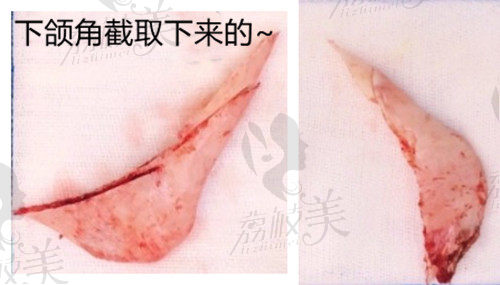 上海薇琳穆雄铮医生做下颌角截骨术后