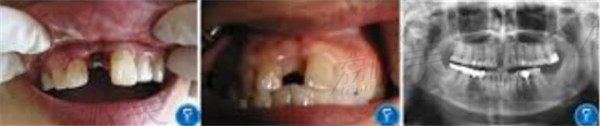 治疗前牙齿状态