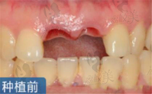 爱齿口腔前牙种植术前范例