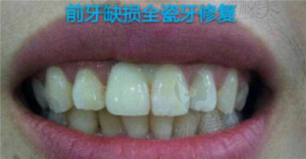 爱齿口腔前牙缺损全瓷冠修复范例术后