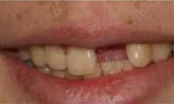 爱齿口腔马志强单颗牙齿缺失术前范例