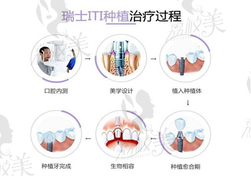 ITI种植牙