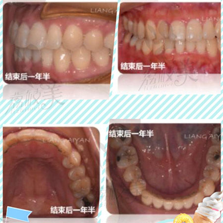 广州马泷齿科隐适美矫正病例