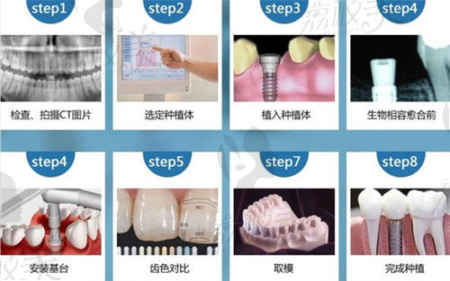 广州马泷齿科种植牙过程优势